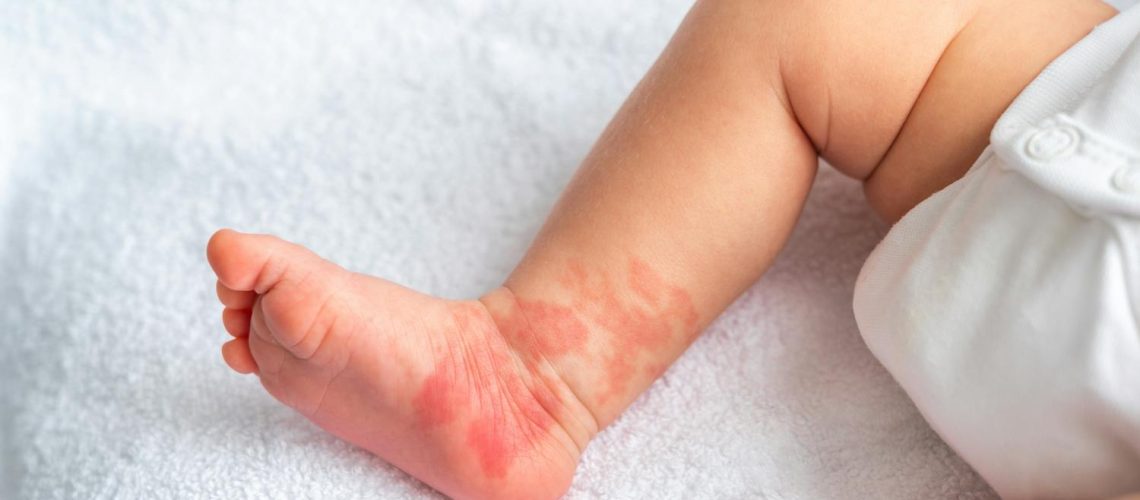 Angiome et hémangiome : quelle est cette tache sur mon bébé ? Angiome et hémangiome : quelle est cette tache sur mon bébé ?