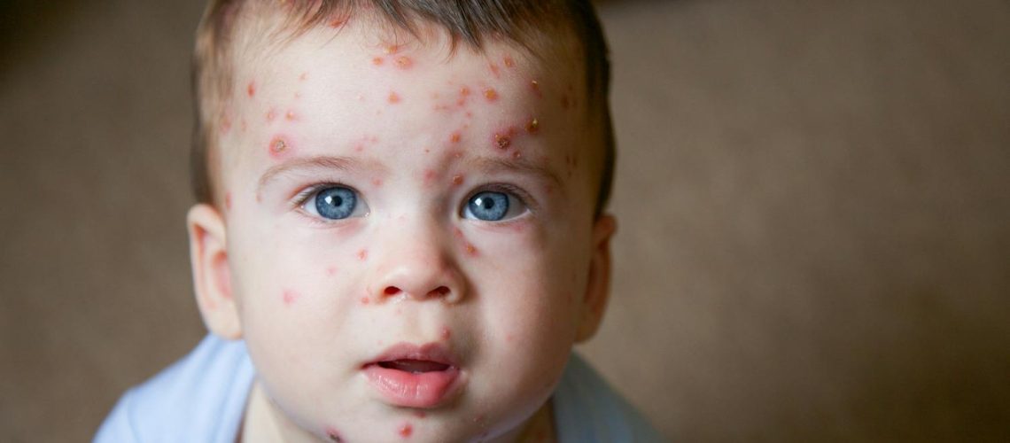 Qu’est-ce qu’un exanthème ? Qu'est-ce qu'un exanthème ?
